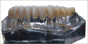 Detailed view of implant-supported prosthetic on model