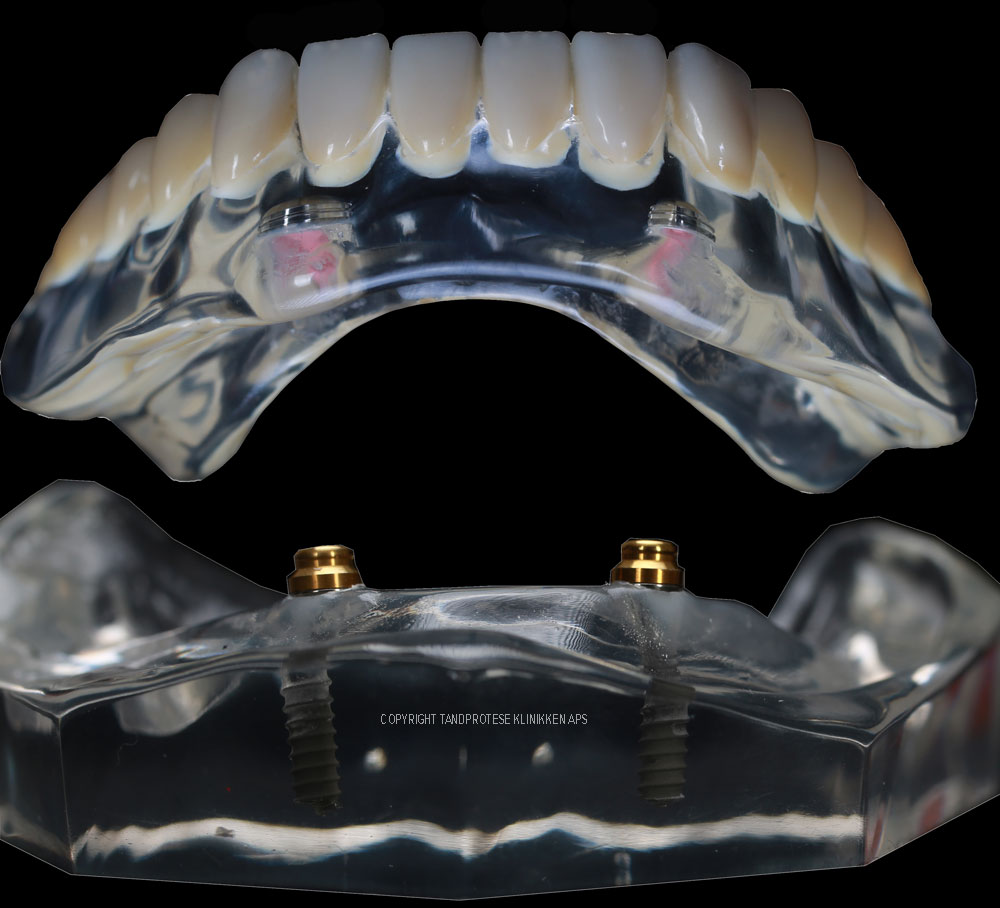 High-quality implant-supported dental prosthetic showing precision fit and natural appearance
