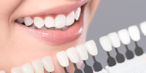 Beautiful smile and white teeth of a young woman. Matching the shades of the implants or the process of teeth whitening.