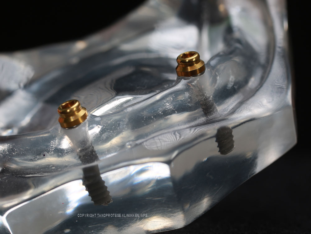 Tandprotese klinikken Implantat (2)